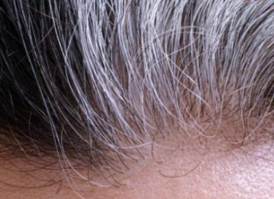 怎么预防白头发越来越多